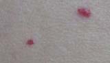 Blood Spot